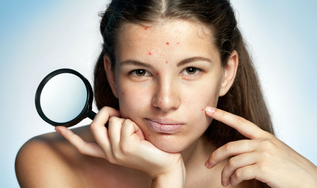 Mariendistel ist ein wirksamer Kämpfer gegen Akne und Ekzeme