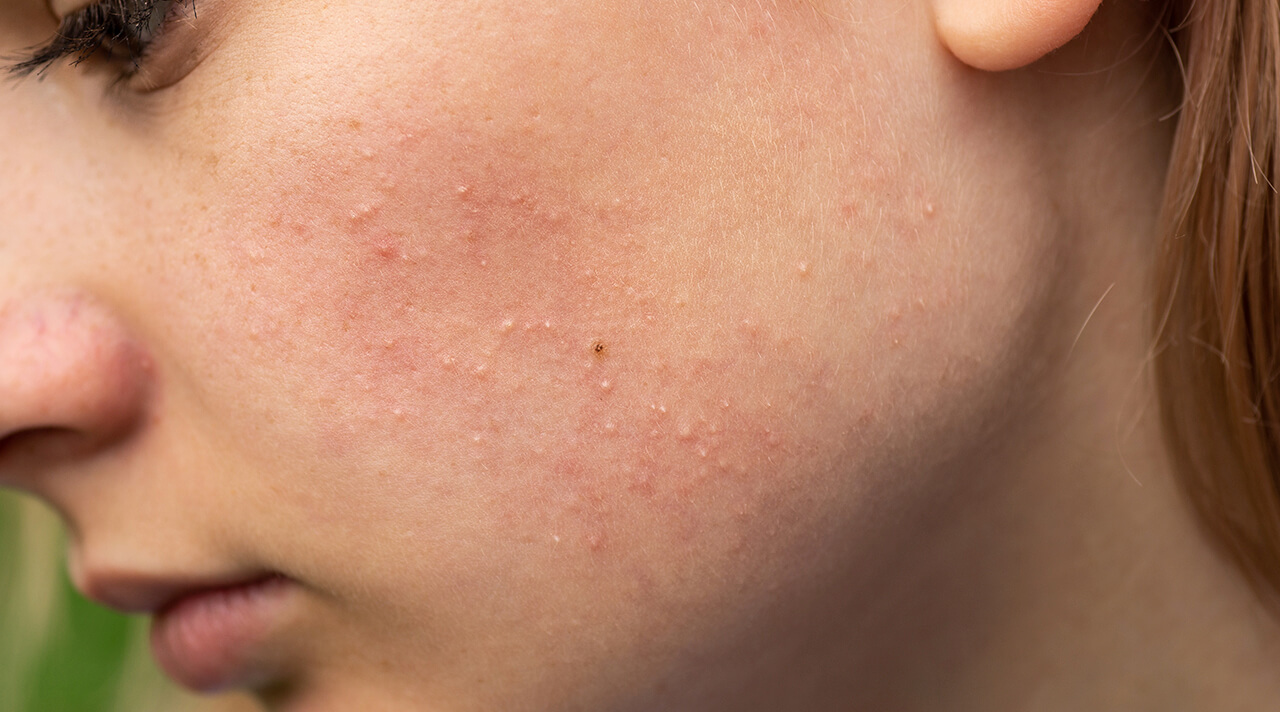 Hautausschlag und Ekzeme sind eine der Manifestationen unerwünschter Giftstoffe im Körper.